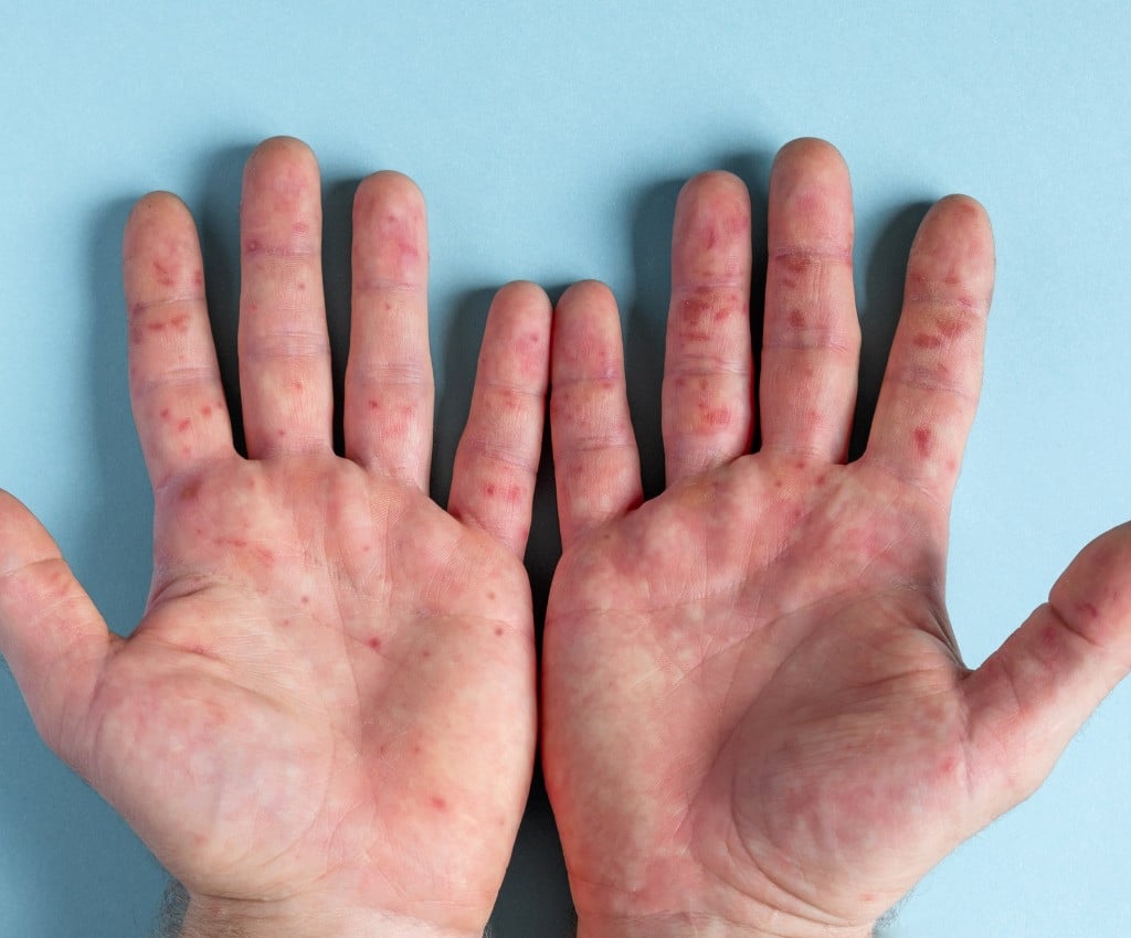 بعد إصابة 4 تلاميذ في الجيزة.. استشاري مناعة يكشف خطورة مرض 